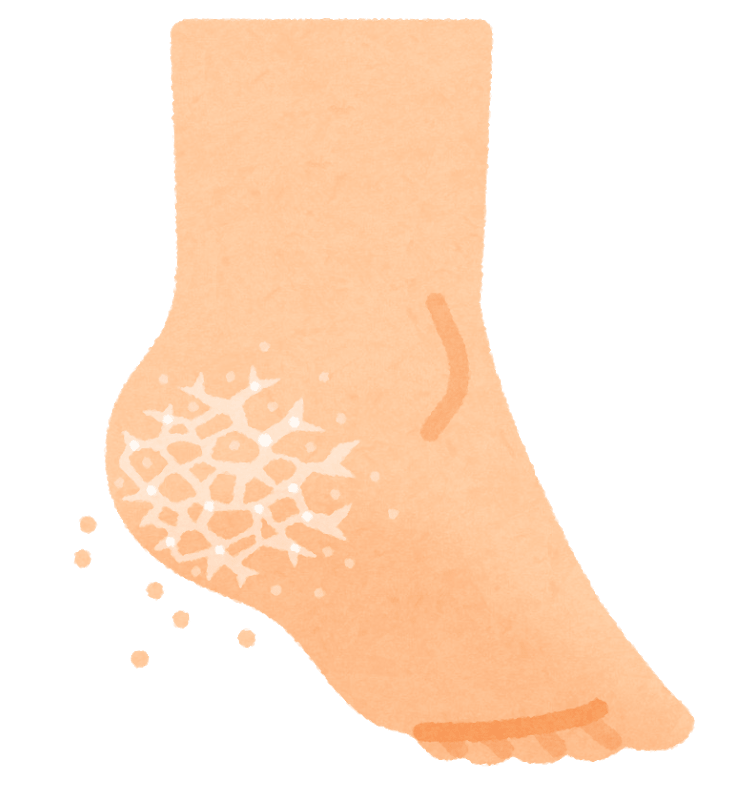 cracked heel