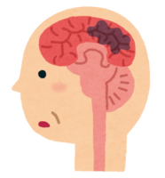 Dementia brain (cerebral vascular)