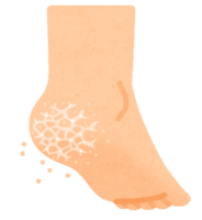 cracked heel
