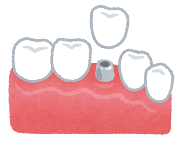 植入物(牙齿治疗)