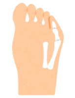 varus little finger