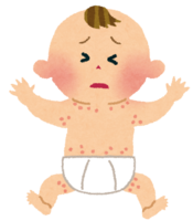 Baby heat rash-eczema