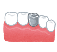銀歯(歯の治療)