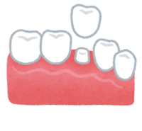 Insert tooth (tooth treatment)