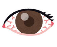 Hyperemic eyes
