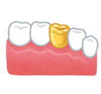 Gold tooth (tooth treatment)