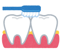 Dental plaque in the interdental area
