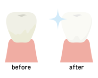 歯のホワイトニングのビフォーアフター